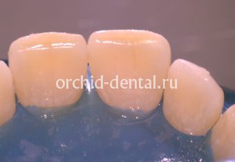 Лечение кариеса центральных зубов небным доступом 