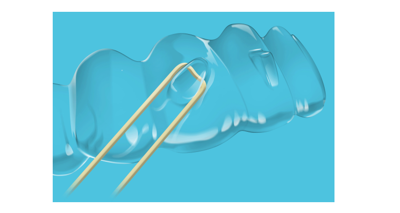 Исправление прикуса на элайнерах Spark™