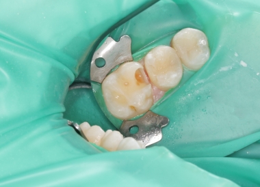Лечение зубов и десен 2