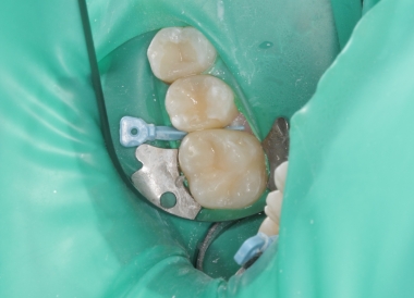 Лечение зубов и десен 3